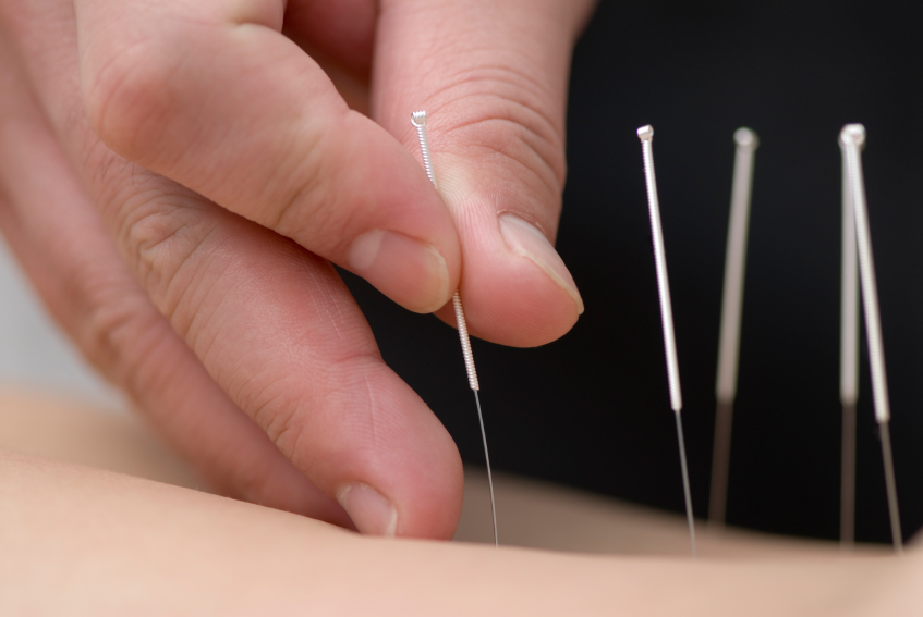 Why Choose a Licensed Acupuncturist Over Dry Needling?